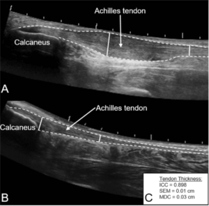 Halbe-Kooter-Castricum-Fysiotherapie-Achillespees-Echografie